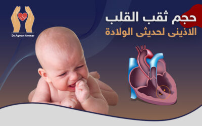 كم يبلغ حجم ثقب القلب الاذيني في الأطفال حديثي الولادة؟